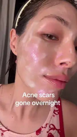 Acne scars
gone overnight