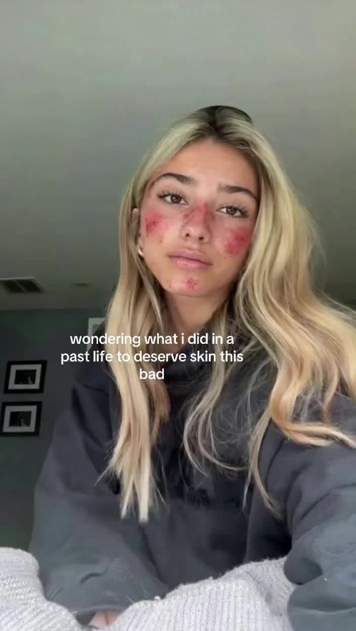 wondering what i did in a
past life to deserve skin this
bad