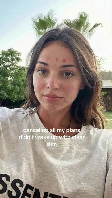 canceling all my plans
didn't wake up with clear
skin