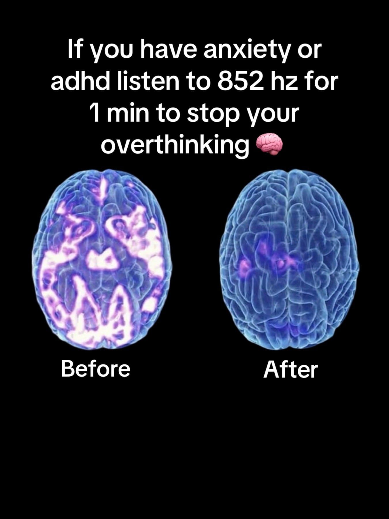 If you have anxiety or
adhd listen to 852 hz for
1 min to stop your
overthinking…