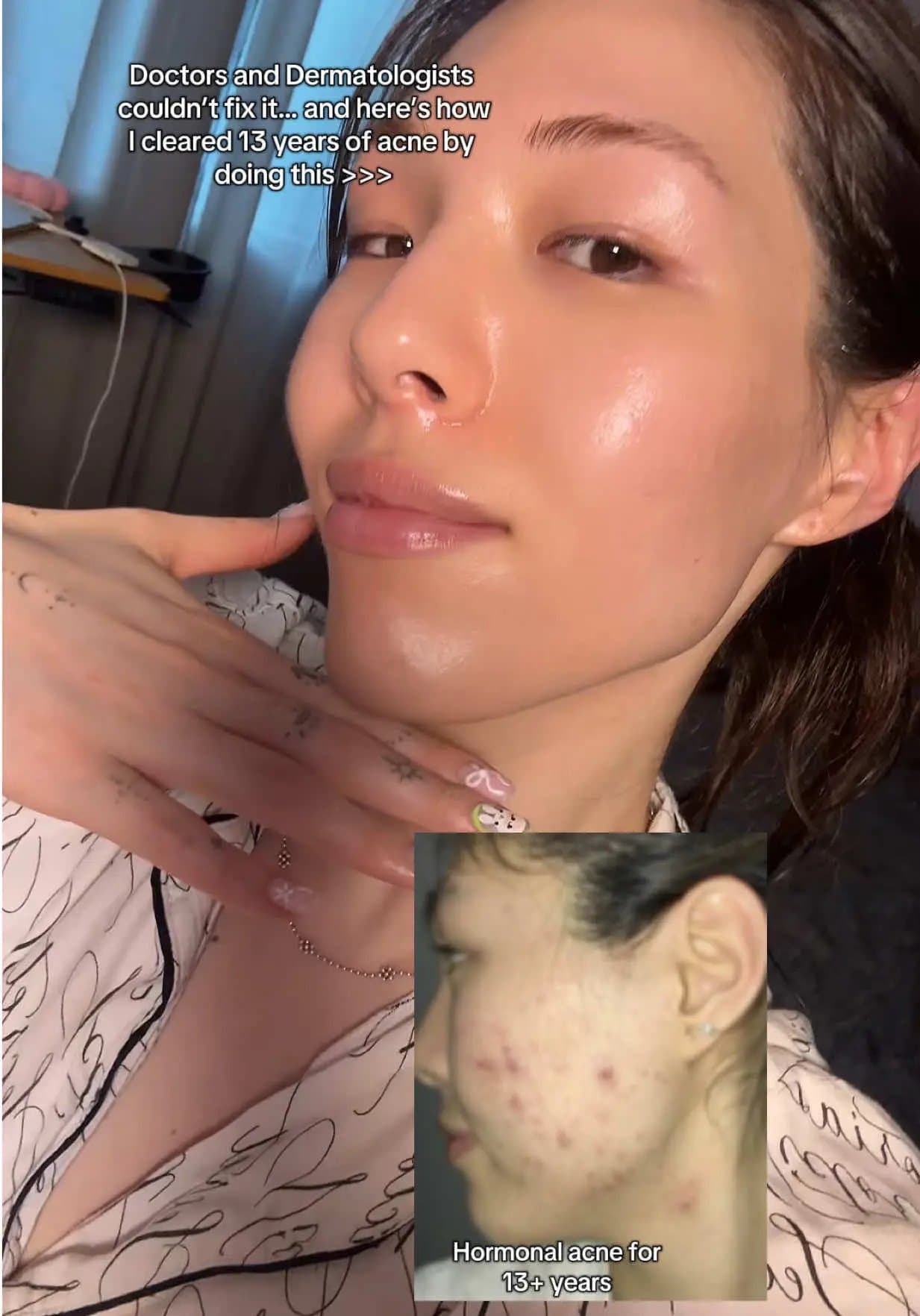 Doctors and Dermatologists
couldn't fix it... and here's how
I cleared 13 years …